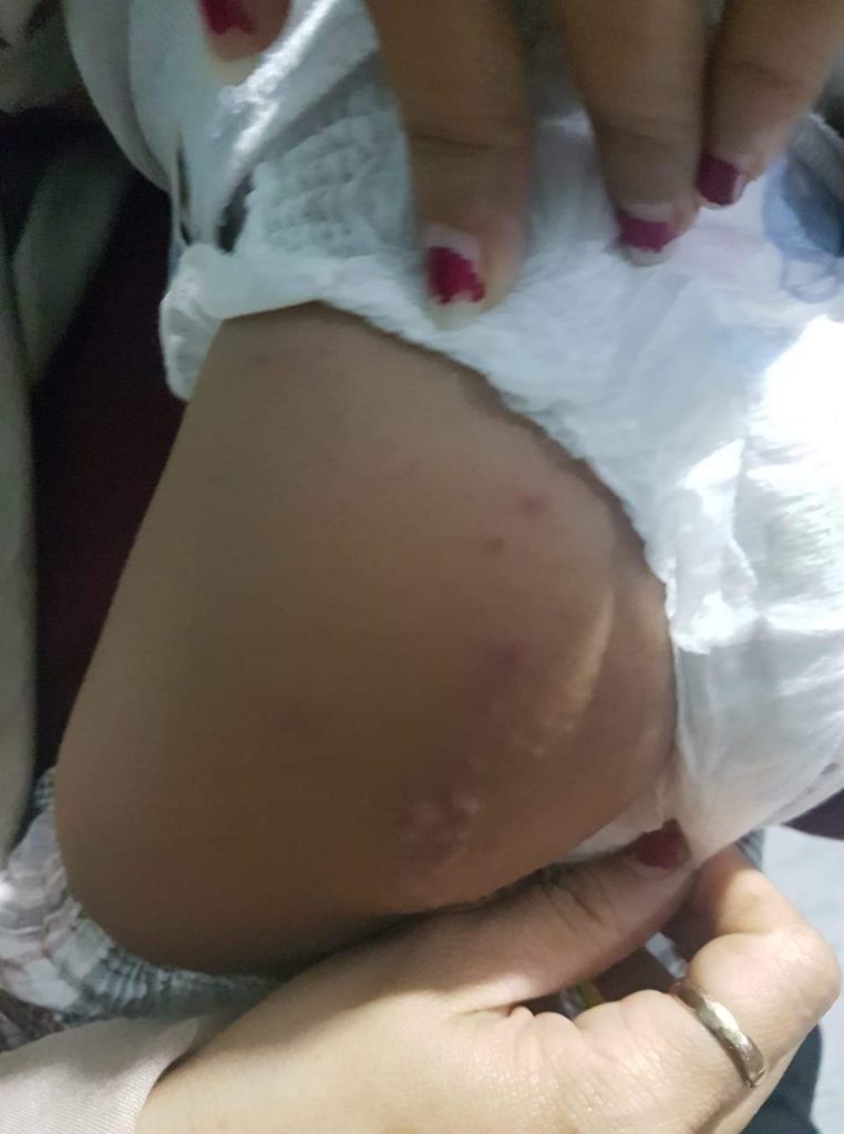 Tegas, Tanjungpinang Belum Ditemukan Monkey pox